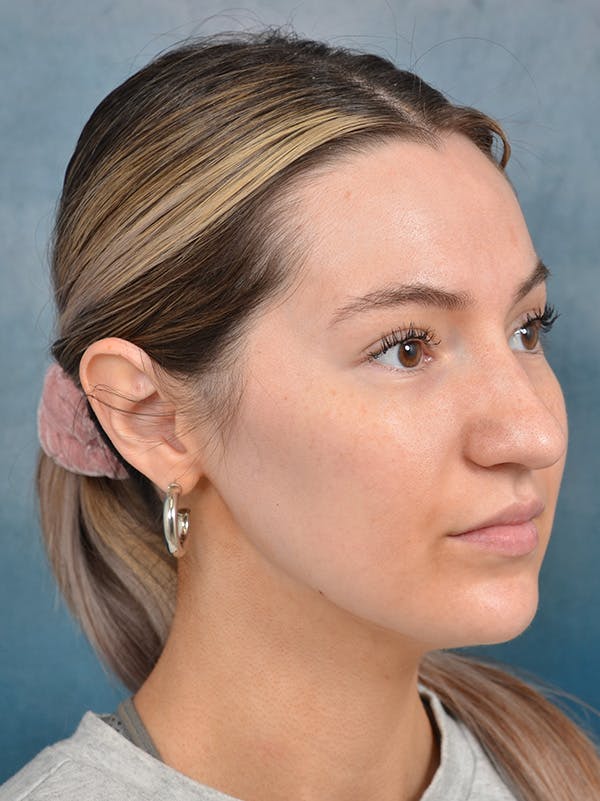 Rhinoplasty Before & After Gallery - Patient 146149881 - Image 5