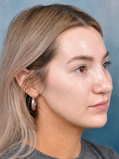 Rhinoplasty Before & After Gallery - Patient 146149881 - Image 6
