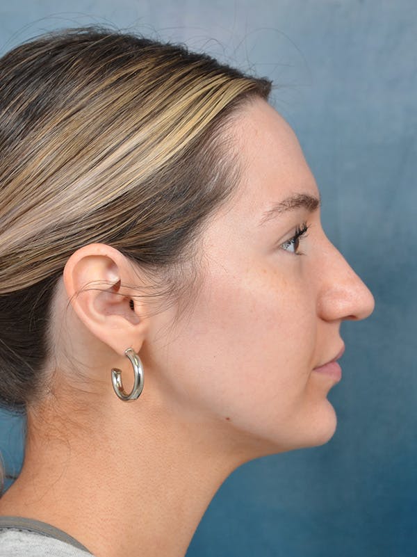 Rhinoplasty Before & After Gallery - Patient 146149881 - Image 7