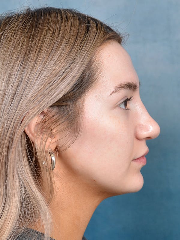Rhinoplasty Before & After Gallery - Patient 146149881 - Image 8