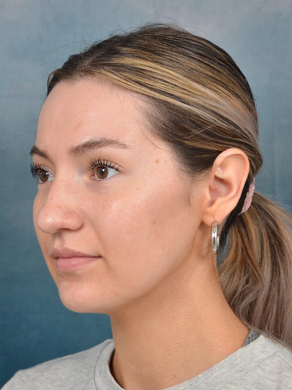 Rhinoplasty Before & After Gallery - Patient 146149881 - Image 9
