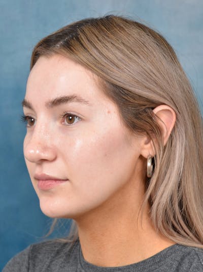 Rhinoplasty Before & After Gallery - Patient 146149881 - Image 10