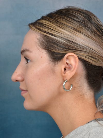 Rhinoplasty Before & After Gallery - Patient 146149881 - Image 1