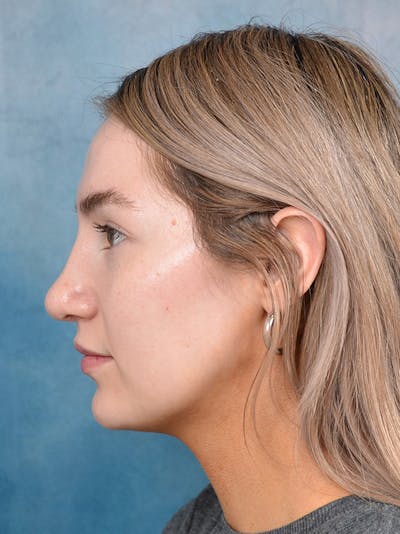 Rhinoplasty Before & After Gallery - Patient 146149881 - Image 2