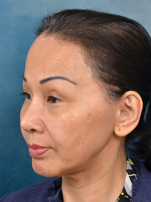 Deep Plane Facelift Before & After Gallery - Patient 146208726 - Image 1
