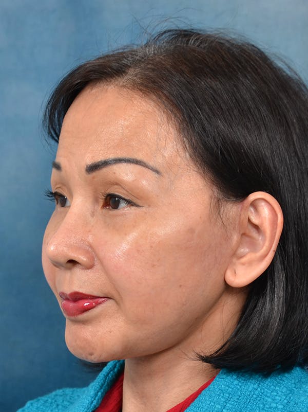 Deep Plane Facelift Before & After Gallery - Patient 146208726 - Image 2