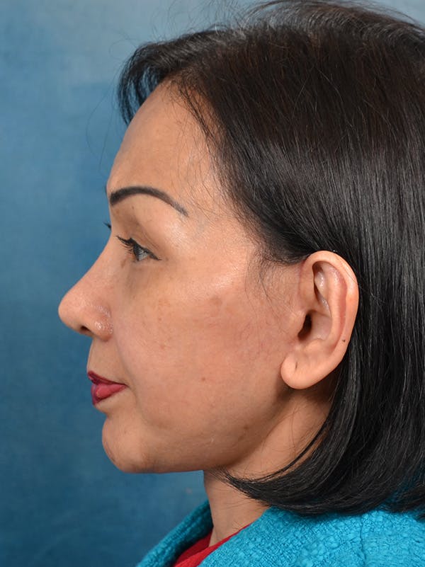 Deep Plane Facelift Before & After Gallery - Patient 146208726 - Image 4