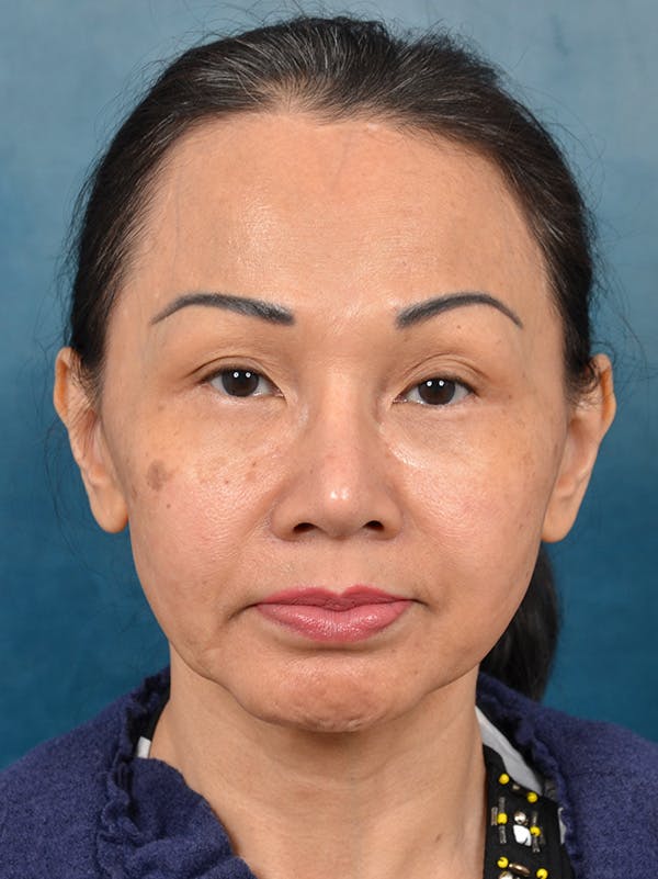 Deep Plane Facelift Before & After Gallery - Patient 146208726 - Image 5