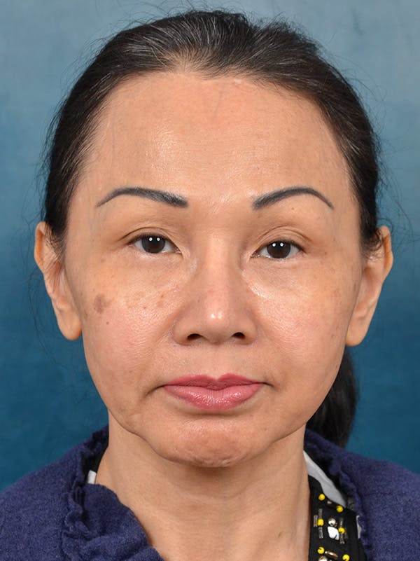 Deep Plane Facelift Before & After Gallery - Patient 146208726 - Image 5