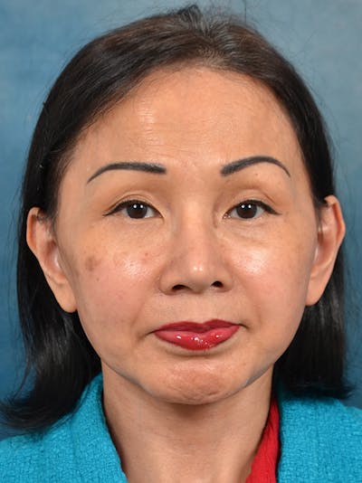 Deep Plane Facelift Before & After Gallery - Patient 146208726 - Image 6