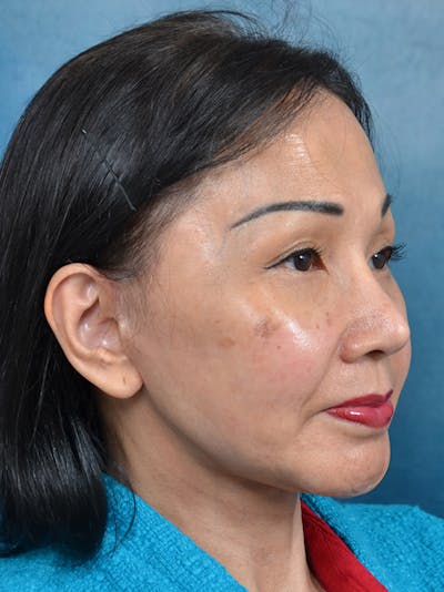 Deep Plane Facelift Before & After Gallery - Patient 146208726 - Image 8