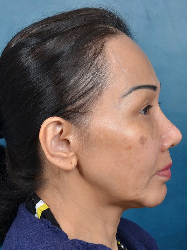 Deep Plane Facelift Before & After Gallery - Patient 146208726 - Image 9