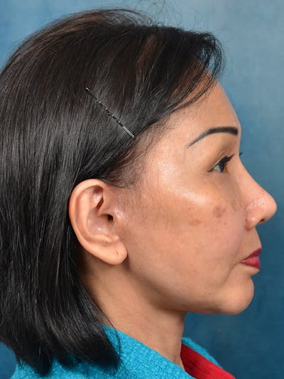 Deep Plane Facelift Before & After Gallery - Patient 146208726 - Image 10