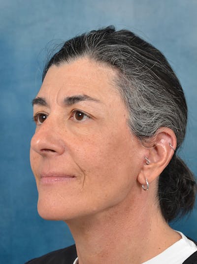 Deep Plane Facelift Before & After Gallery - Patient 146898878 - Image 2