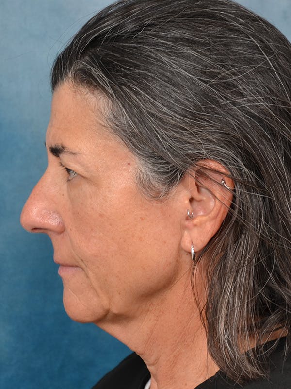 Deep Plane Facelift Before & After Gallery - Patient 146898878 - Image 3
