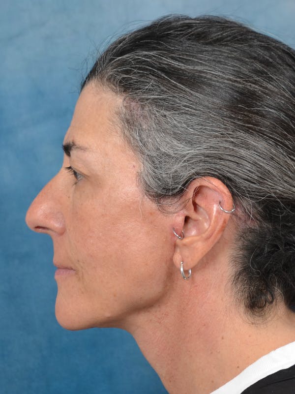 Deep Plane Facelift Before & After Gallery - Patient 146898878 - Image 4