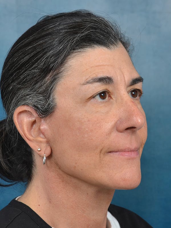 Deep Plane Facelift Before & After Gallery - Patient 146898878 - Image 8