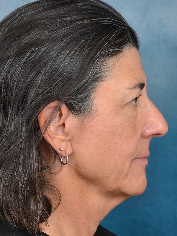 Deep Plane Facelift Before & After Gallery - Patient 146898878 - Image 9