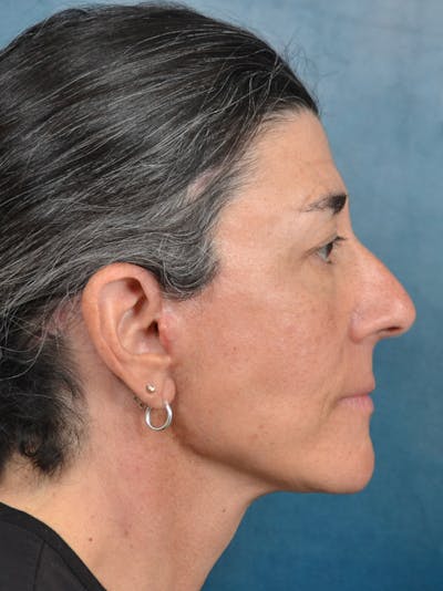 Deep Plane Facelift Before & After Gallery - Patient 146898878 - Image 10
