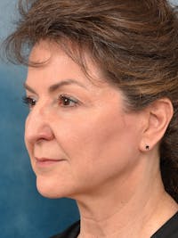 Deep Plane Facelift Before & After Gallery - Patient 146208730 - Image 1