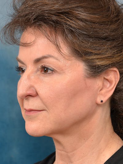 Deep Plane Facelift Before & After Gallery - Patient 146208730 - Image 1