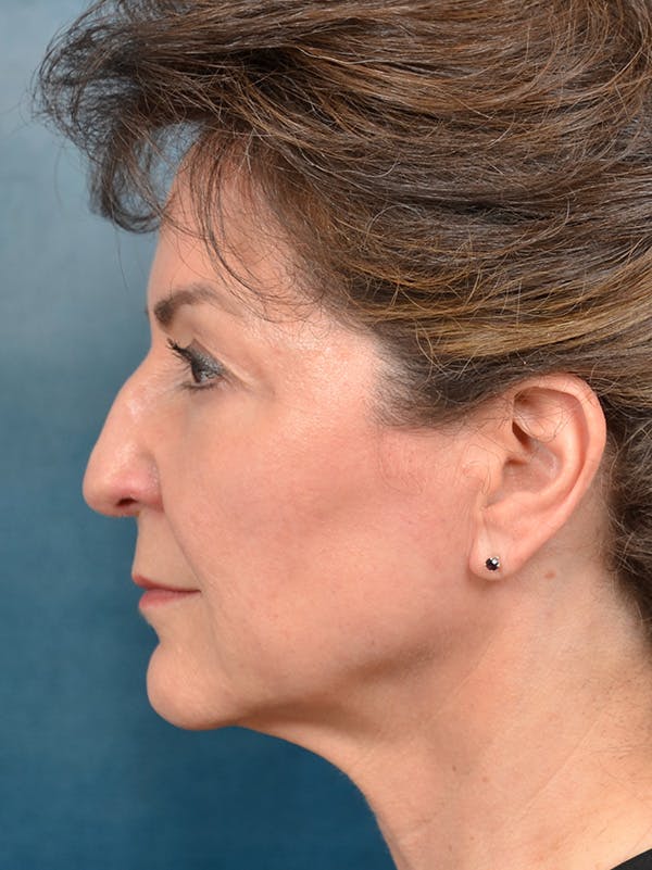 Deep Plane Facelift Before & After Gallery - Patient 146208730 - Image 3