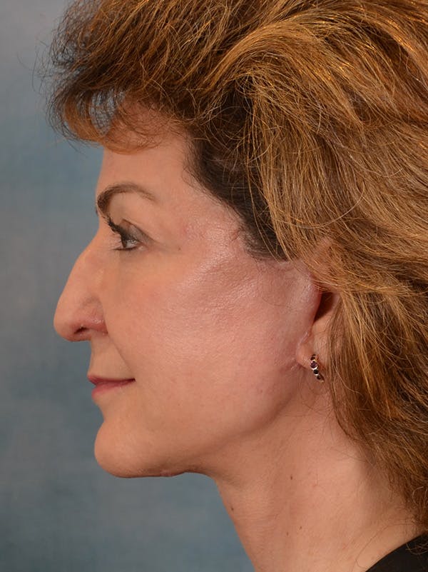 Deep Plane Facelift Before & After Gallery - Patient 146208730 - Image 4