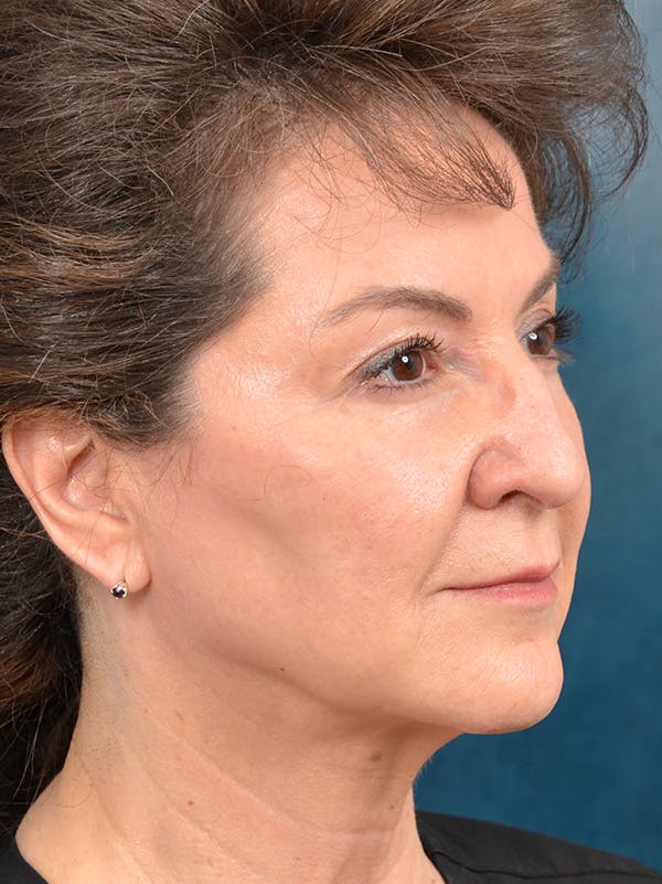 Deep Plane Facelift Before & After Gallery - Patient 146208730 - Image 7