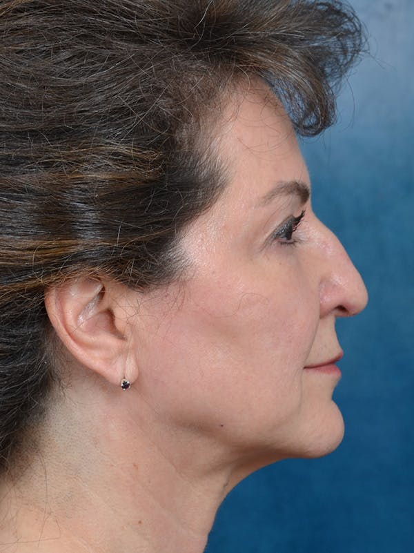 Deep Plane Facelift Before & After Gallery - Patient 146208730 - Image 9