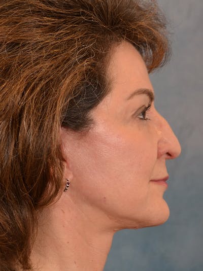 Deep Plane Facelift Before & After Gallery - Patient 146208730 - Image 10