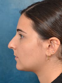 Rhinoplasty Before & After Gallery - Patient 146208551 - Image 1