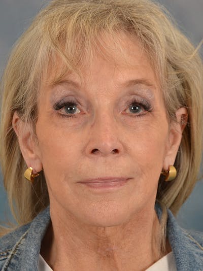 Deep Plane Facelift Before & After Gallery - Patient 146208584 - Image 4