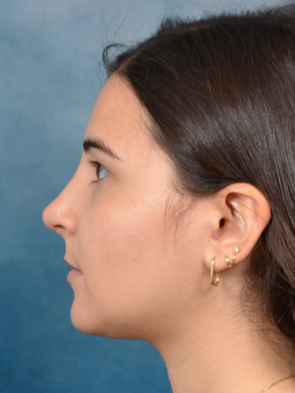 Rhinoplasty Before & After Gallery - Patient 146208551 - Image 2
