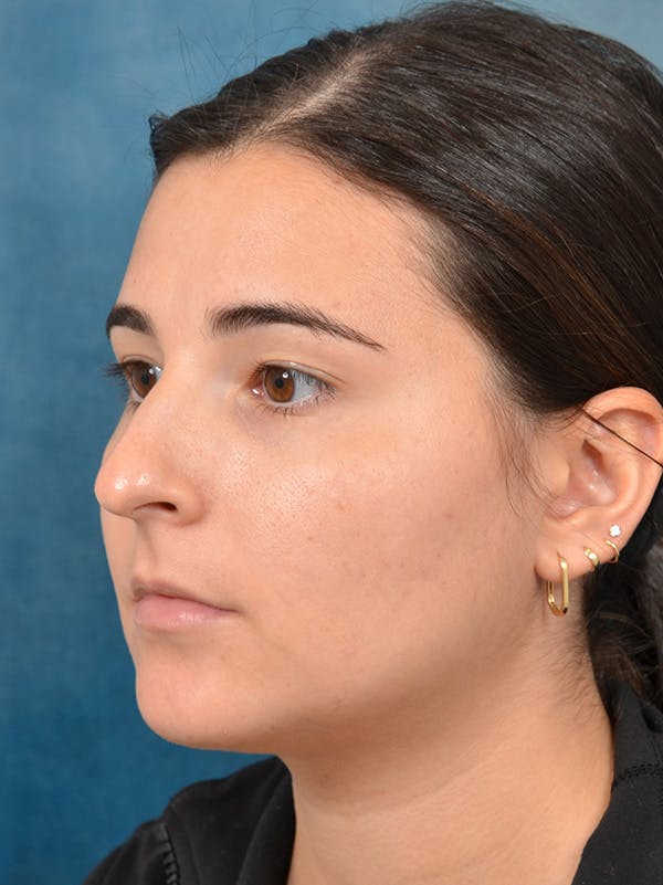 Rhinoplasty Before & After Gallery - Patient 146208551 - Image 3
