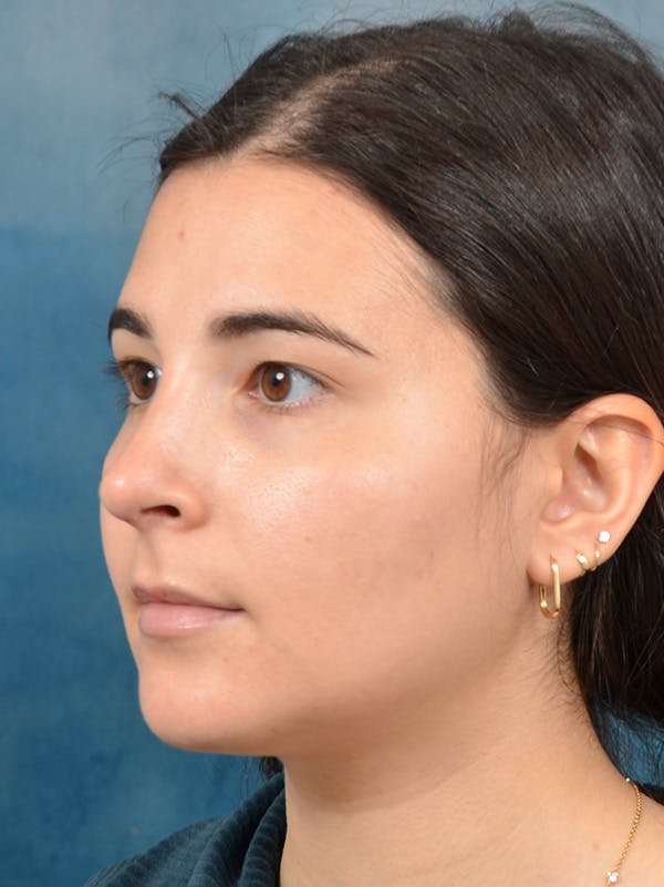 Rhinoplasty Before & After Gallery - Patient 146208551 - Image 4