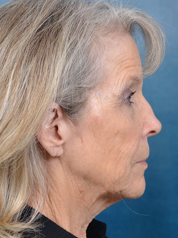 Brow Lift Before & After Gallery - Patient 146208956 - Image 5