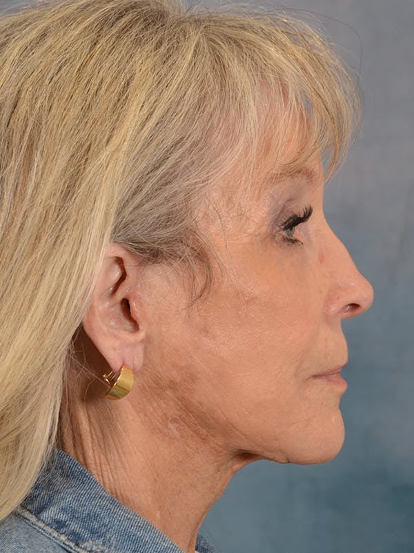 Brow Lift Before & After Gallery - Patient 146208956 - Image 6