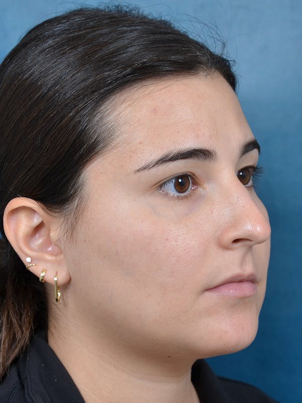 Rhinoplasty Before & After Gallery - Patient 146208551 - Image 7