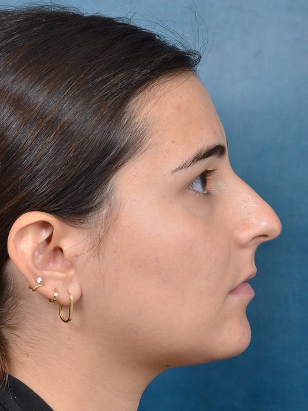 Rhinoplasty Before & After Gallery - Patient 146208551 - Image 9