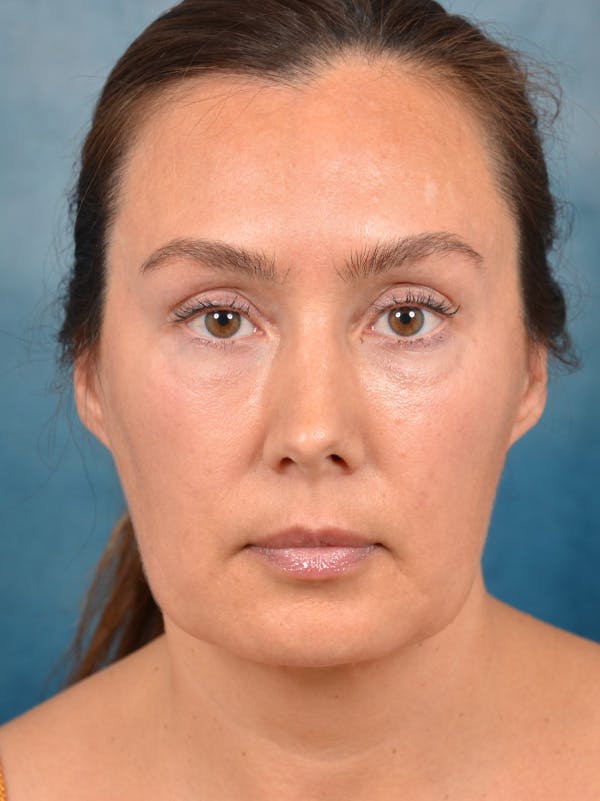 Eyelid Lift Before & After Gallery - Patient 146208591 - Image 1