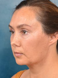 Deep Plane Facelift Before & After Gallery - Patient 146208590 - Image 1