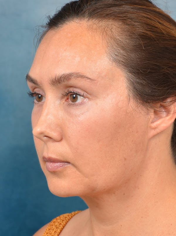 Eyelid Lift Before & After Gallery - Patient 146208591 - Image 3