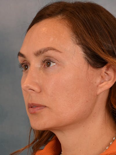 Deep Plane Facelift Before & After Gallery - Patient 146208590 - Image 2