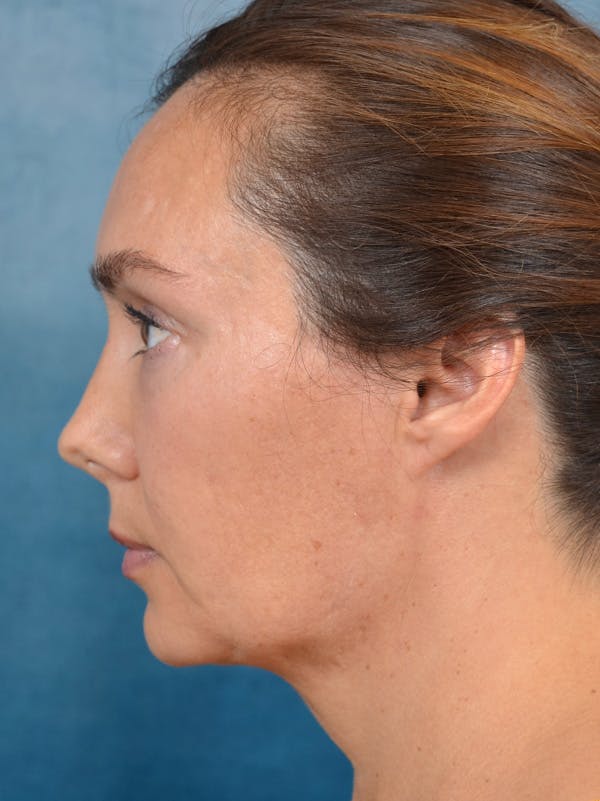 Deep Plane Facelift Before & After Gallery - Patient 146208590 - Image 5