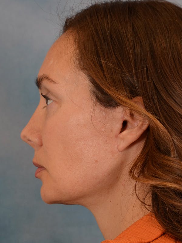 Eyelid Lift Before & After Gallery - Patient 146208591 - Image 6