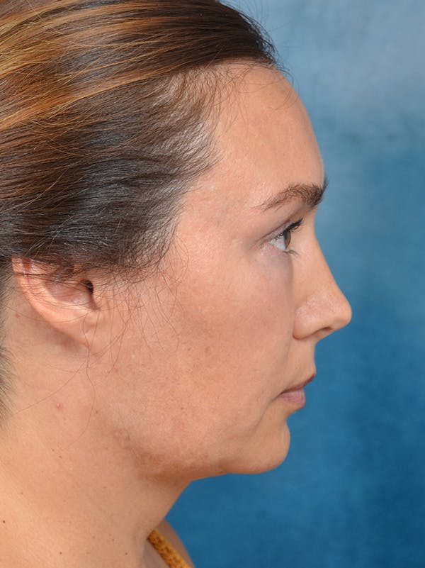 Deep Plane Facelift Before & After Gallery - Patient 146208590 - Image 9