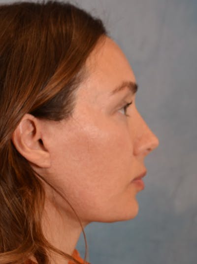 Deep Plane Facelift Before & After Gallery - Patient 146208590 - Image 10