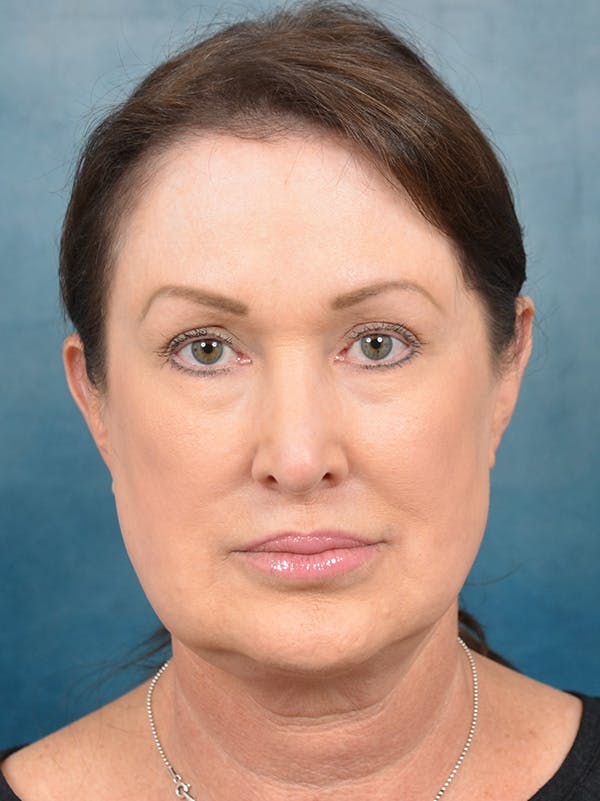 Deep Plane Facelift Before & After Gallery - Patient 146208595 - Image 3