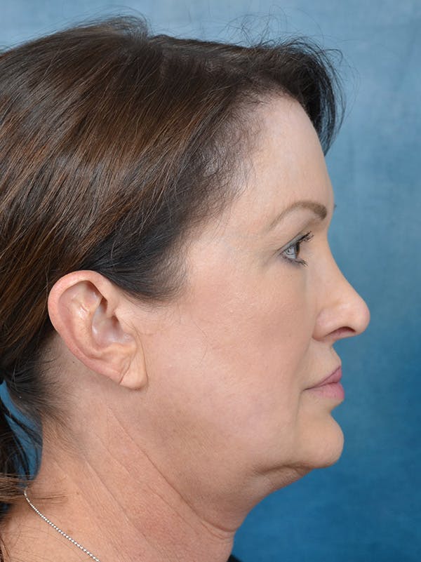 Deep Plane Facelift Before & After Gallery - Patient 146208595 - Image 7