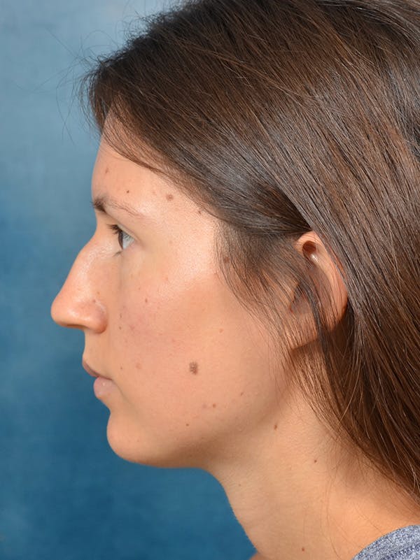 Rhinoplasty Before & After Gallery - Patient 146208553 - Image 1